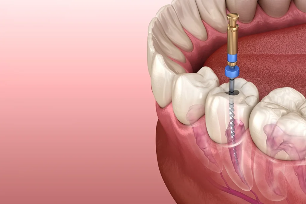 procedimiento de endodoncia